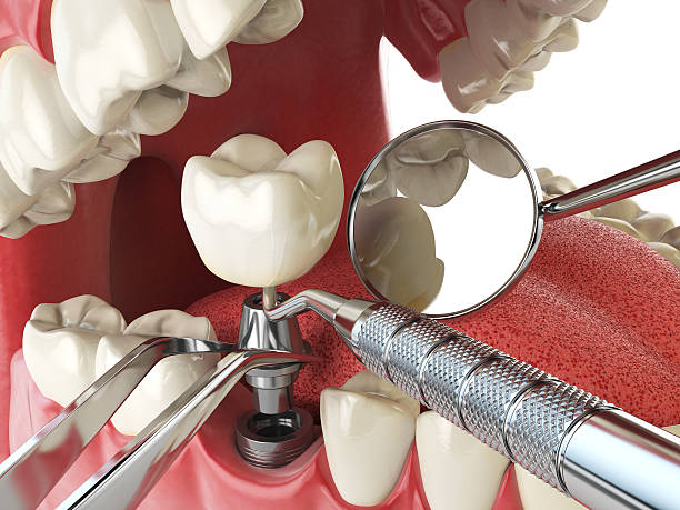 Best Lost Filling or Crown Replacement in Smyrna, GA